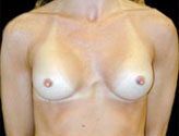 Patient # 39698 After Photo # 2